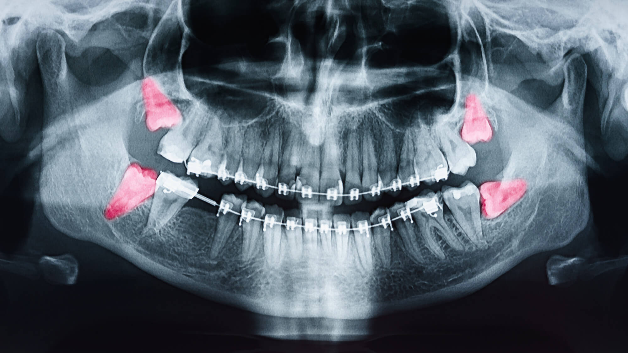 wisdom-teeth-removal